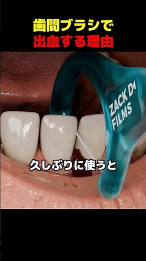 Why do interdental brushes cause bleeding?