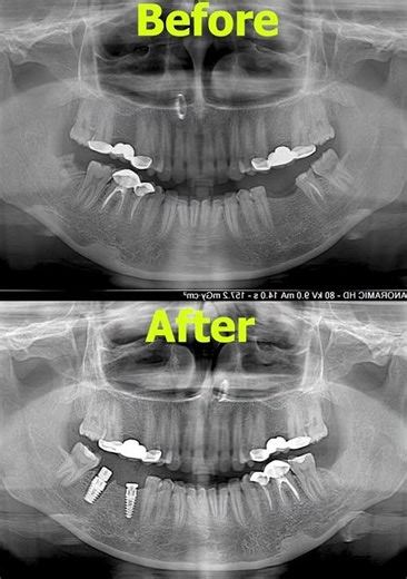 Dual posterior implants placed after extraction of failing molar and missing tooth.