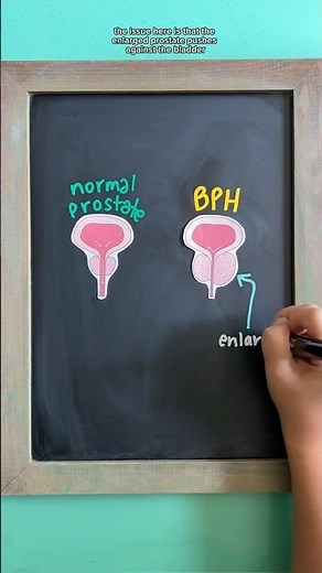 BENIGN PROSTATIC HYPERPLASIA (BPH) NCLEX Review