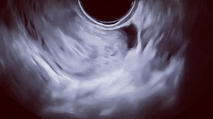 El signo de deslizamiento (“sliding sign”) es una prueba diagnóstica, simple, que puede utilizarse por el ultrasonografista. Cuando el “sliding sign” es POSITIVO, en un útero retrovertido, se predice un fondo de saco de Douglas, no borrado. ‪#Endometriosis #Ginecología #ObGyn #Gine #Gineco‬ #ginecologo #Ultrasonido #Ecografía #Xalapa #XalapaCity #xalapaenríquez | Dr. Roberto Medina Barradas.