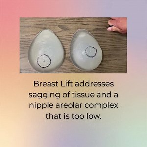 Basics of mastopexy with or without implants