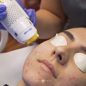 "We used @NeoClearbyAerolase to combat cystic acne which had a severe impact on my patient’s confidence. NeoClear is a gentle yet highly effective laser that goes deep into the surrounding tissue to kill the bacteria which produces acne flare-ups." - Danielle Stark, PA for Dr. Jason Emer | Aerolase
