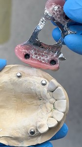 Metal Locator Partial! Case from Dr. Michael Cheng in Illinois! | Luke Kahng