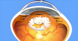 Posterior Capsule Opacification After Cataract Surgery Stock Footage Video (100% Royalty-free) 34995703 | Shutterstock