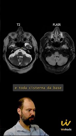 Recognize Brain Atrophy on Magnetic Resonance Imaging