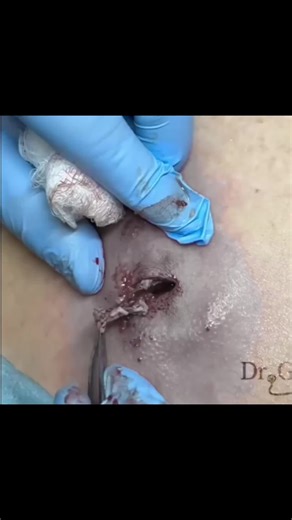 Part 14 #pimples #popping #pimplespopping #doctor #viral