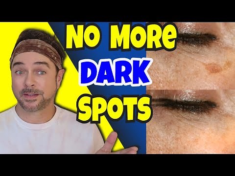 Amazing Dark Skin Spot Remover Under $20 Bucks | Chris Gibson