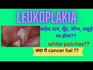 leukoplakia||white patch|| causes and treatment ||