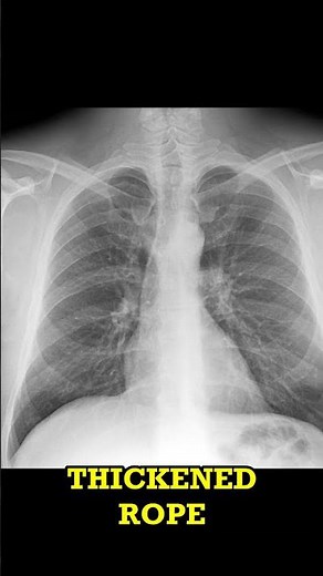 Chronic Bronchitis on X-ray Quick Radiology Short