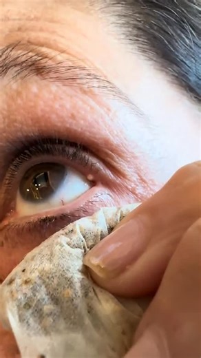 Anne Caserta on Instagram: "No need for over-the-counter stye medicine! This works within an hours #stye #eye #nature #tea"