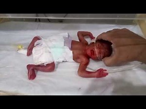 premature baby crying, premature baby, crying, newborn baby crying