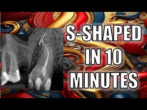 How to Hand File: Navigating Complex S-Curved Root Canals Efficiently | Endo Uncut