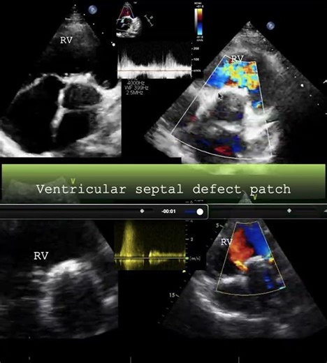 Ventricular septal defect patch