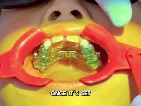 How Orthodontists Install a 3D Printed Jaw Expander | Quick Review