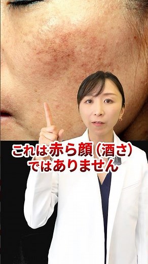 【皮膚科医が解説】これは赤ら顔ではありません。治療法について解説。