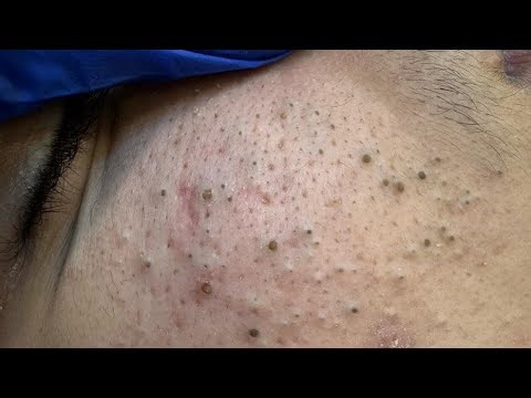 Deep Cleansing Techniques for Blackheads & Pimple Treatment - Satisfying Facial Care Routine