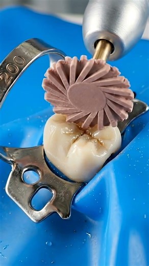 Impregnated Spiral Wheels ®️#dentistry #dentist