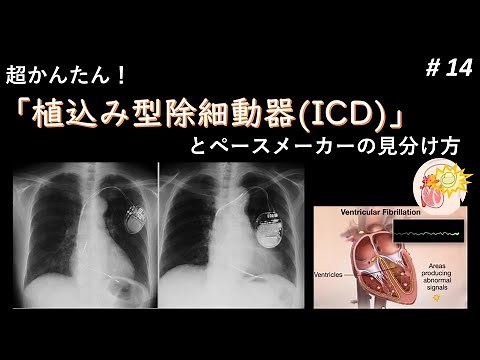 #14 Super Easy! How to Distinguish Between an Implantable Cardioverter Defibrillator (ICD) and a ...