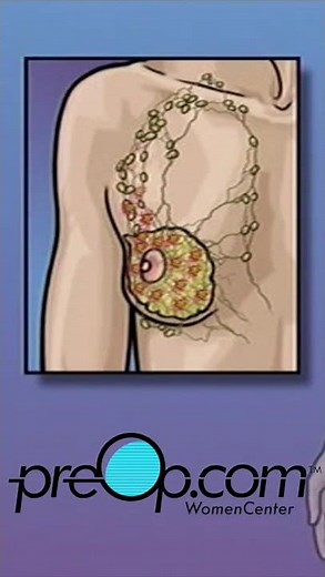 🔍 PreOp® Mastectomy – Modified Radical Patient Ed 💡Clinical Skills Made Simple✨ #shorts