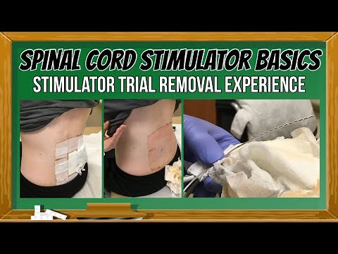 Spinal Cord Stimulator Trial Removal (Includes SCS & DRG Trial Removal Footage)