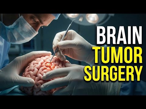 From Diagnosis to Recovery. Removing a Tumor From the Human Brain: Complete Process. #3danimation