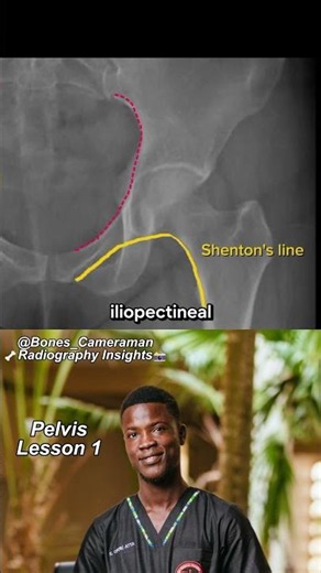 How to Read a Pelvis X-Ray in 60 Seconds | X-Ray Basics