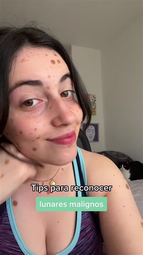 Reconocimiento de Lunares Malignos: Tips ABCDE