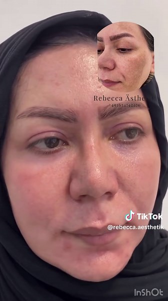 Effective Melasma Treatment Options for Clear Skin