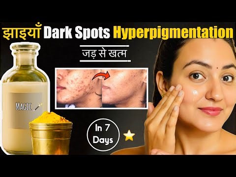 7 Days Skin Challenge : Remove Dark Spots, Acne Scars, Pimple Marks & Pigmentation | 100% Results💕