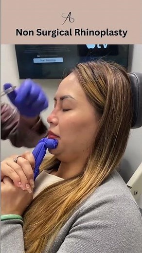 Why Non- Surgical Rhinoplasty?! | Reshape Nose! | Before & After!
