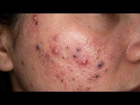 Loan Nguyen Acne Treatment 30kk1