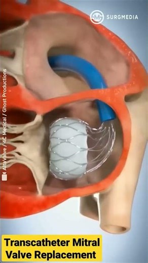 ❤️‍🔥 हार्ट फेलियर का इलाज – नया तरीका जिसने सबको चौंका दिया!