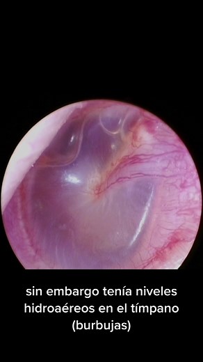 Sensación de Oído Tapado: Otitis Media Serosa y Otros Síntomas Comunes