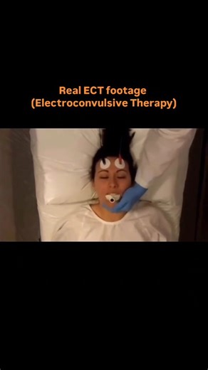 Aarti on Instagram: "1. ECT (Electroconvulsive Therapy) is a psychiatric treatment using a controlled electric current to induce a therapeutic seizure. 2. It is mainly used for severe depression with suicidal tendency and treatment-resistant depression. 3. Other indications include catatonia, mania, schizophrenia with catatonic features. 4. Absolute contraindication: Raised intracranial pressure (ICP). 5. Relative contraindications: Recent MI, uncontrolled hypertension, aneurysm, severe cardiac 