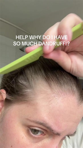 How to Address Severe Dandruff Issues