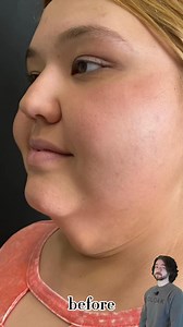 Look at this beautiful neck transformation with PDO THREADS💉🌻✅PDO Threads are extremely safe and effective✅Last up to 2 YEARS✅Stimulate new collagen ✅NOT A SURGERY AND NO DOWNTIME✅Brightens skin tone👩🏻‍⚕️Our Family Nurse Practitioner is the FOUNDER/ PIONEER of the PDO Threads in the Valley👩🏻‍⚕️Call now to set up your appointment for your consultation📱————————————————————————Mira esta hermosa transformación de Cuello con Hilos PDO💉🌻✅Los hilos PDO son extremadamente seguros y efectivos✅Du