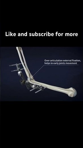 Elbow External Fixator: #orthopedicsurgery for #ElbowFractures Explained