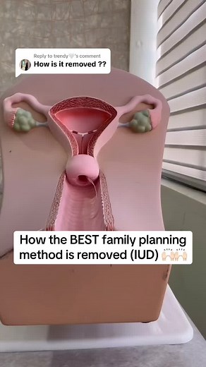 Understanding IUD Removal for Effective Family Planning