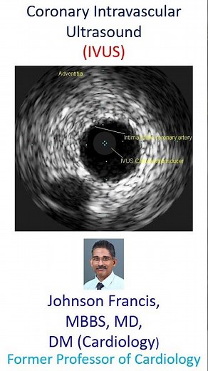 Coronary Intravascular Ultrasound (IVUS)