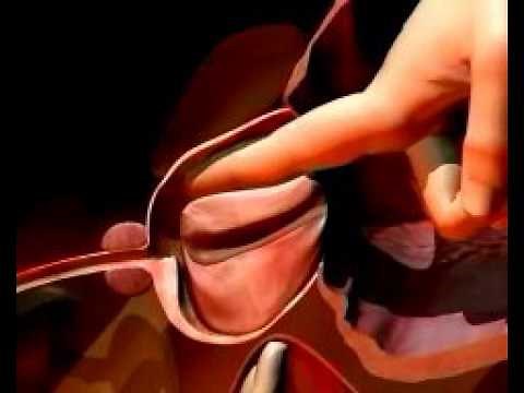 Adenomectomia prostatica (animazione)