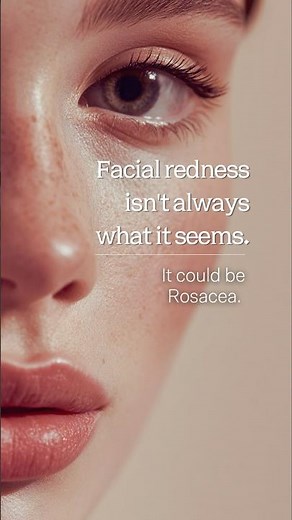 Facial redness isn't always what it seems. It could be Rosacea