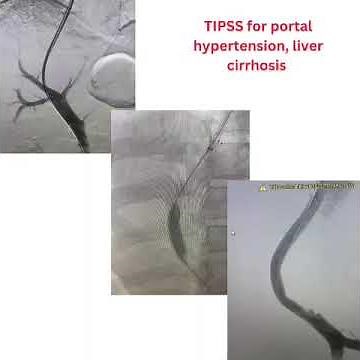TIPSS Procedure for Liver Cirrhosis by Dr. Suresh Giragani