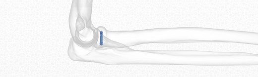 REDUCT® Headless Compression Screw - Skeletal Dynamics