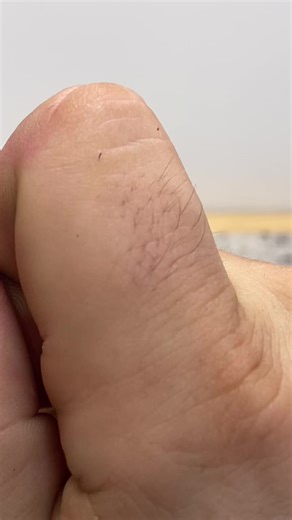 Effective Ways to Remove Stubborn Splinters