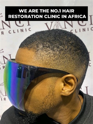 Free Hair Restoration Consultation at Vinci Hair Clinic