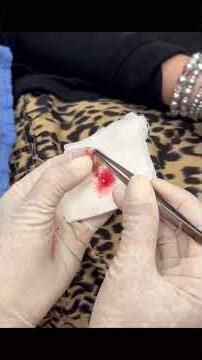 A Sweet Gem Cyst on the Face