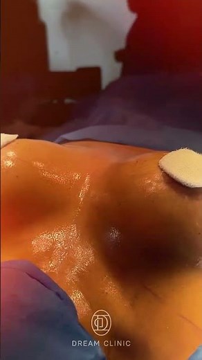 Mastopexy with Prosthesis Replacement – ​​Immediate Before and After | Dr. Ícaro Samuel