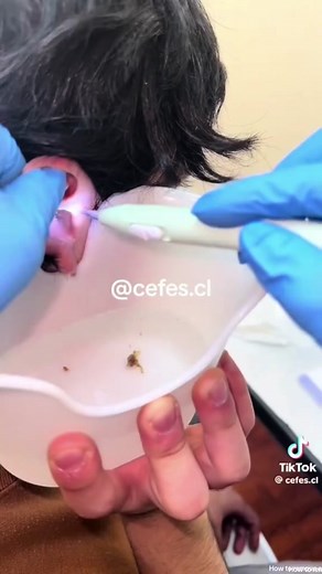 #stitch with @Cefes.cl How To Get Wax Out Of Ear with Debrox #earwaxspecialist #earwaxremovaltok #cleanyourears