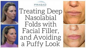 How Filler can Improve Depth of the Nasolabial Folds without Making the Face Look Puffy