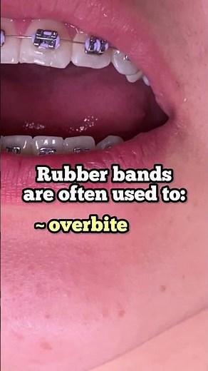 Why Use Rubber Bands With Braces? Toothtime Family Dentistry New Braunfels #braces #dentaltreatment